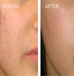 Acne scar treatment