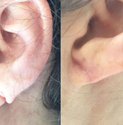 Ear Lobe Repair and Ear Piercing