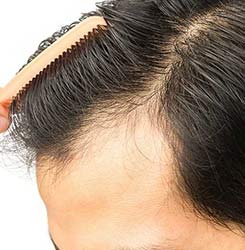 Hair Transplant