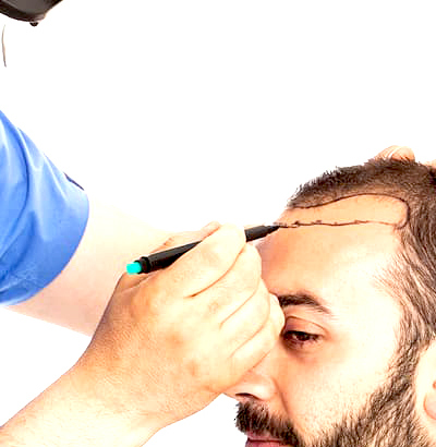 Best Hair Transplant In Indore