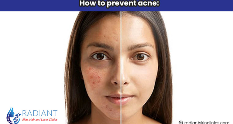 How to prevent acne:
