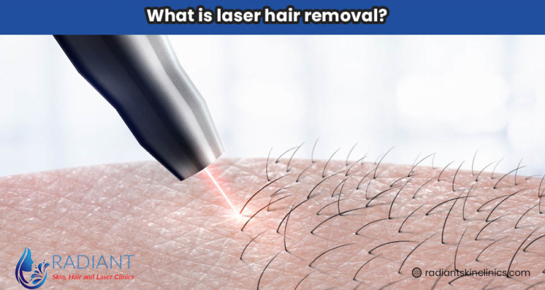 What is laser hair removal?