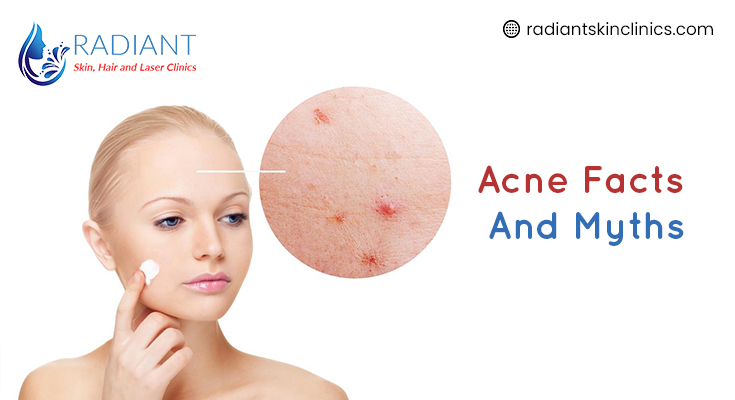 Acne facts and myths: - Radiant Skin Hair and laser Clinic