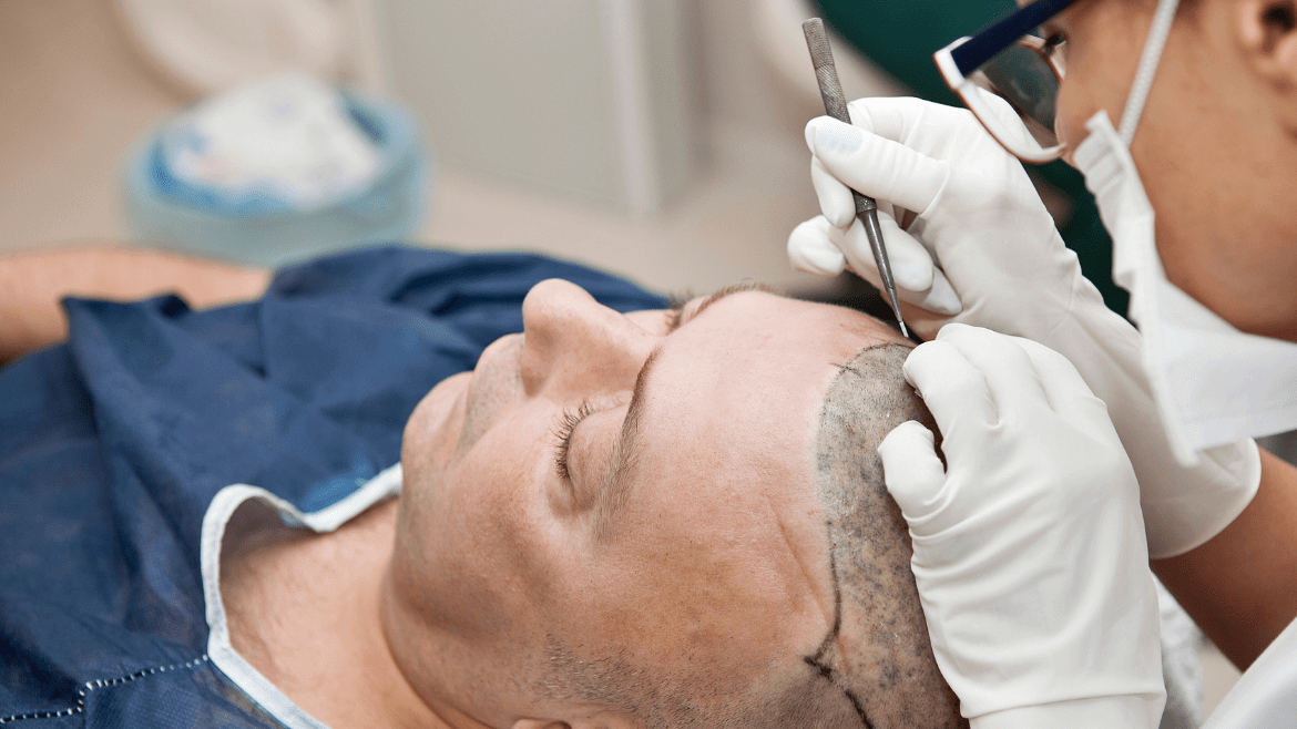 Common Myths about Hair Transplant and the Real Facts