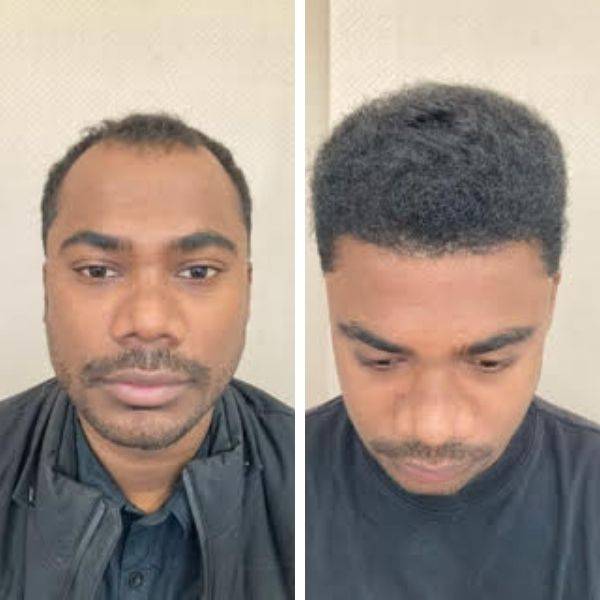 Before After result of 2800 Grafts Hair Transplant