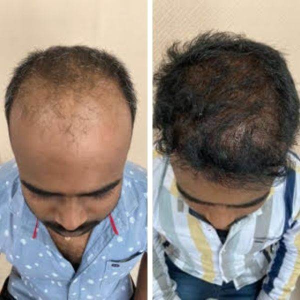 Before After result of 4000 Grafts Hair Transplant