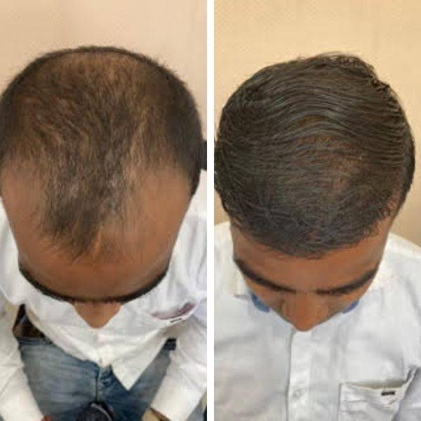 Before After result of 3500 Grafts Hair Transplant
