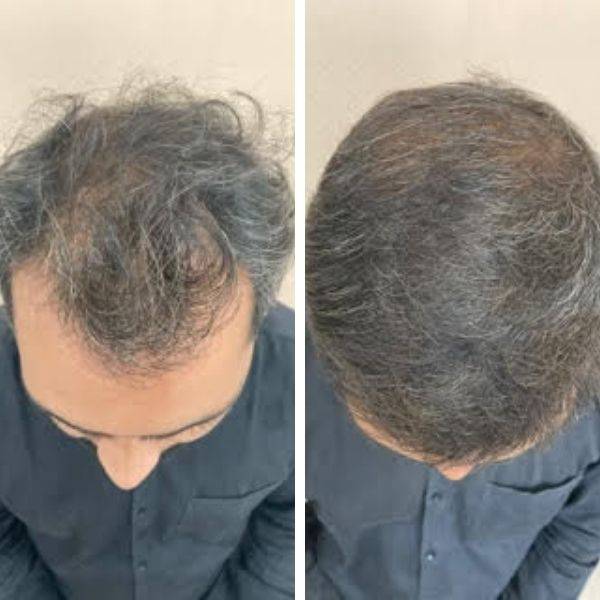 Before After result of 2800 Grafts Hair Transplant