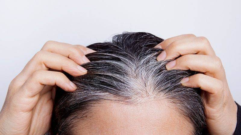 Premature Grey Hair treatment in Indore at Lowest Cost