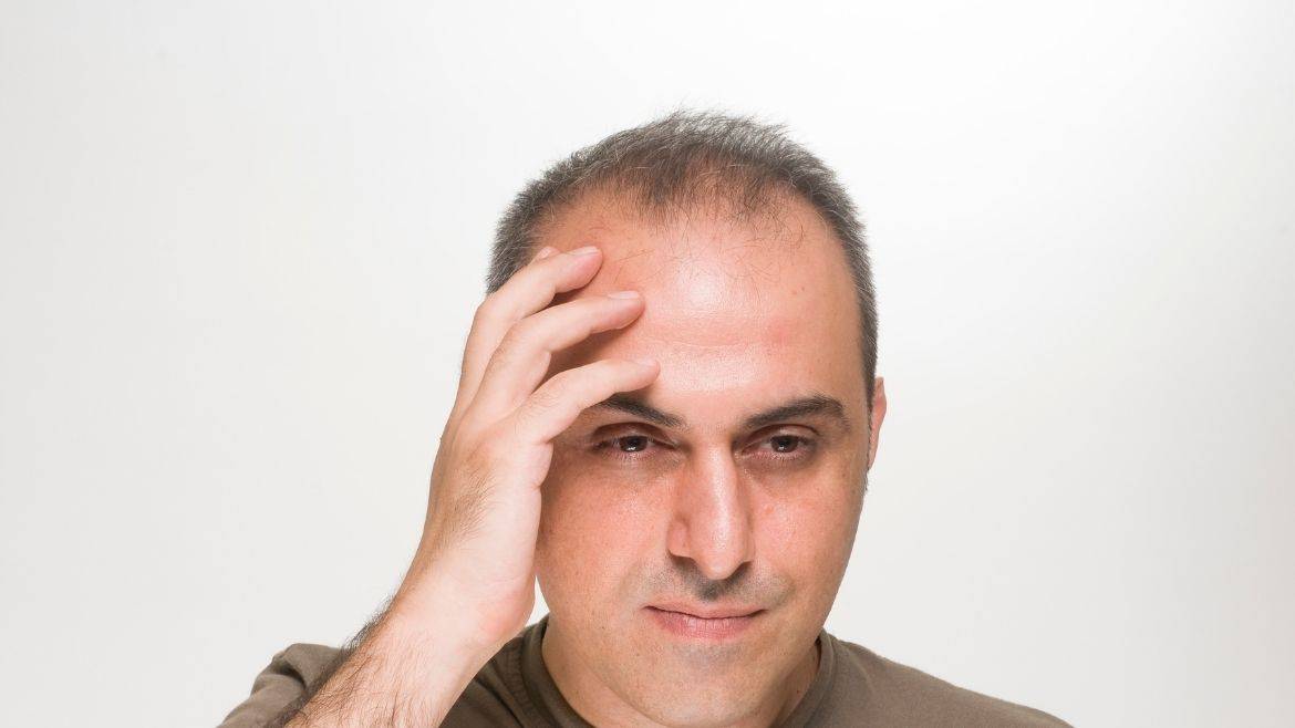 Why Does Baldness Occur in Men? Is It Curable?