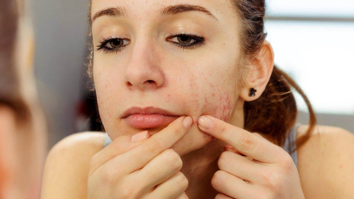 Hormonal Acne: Causes, Symptoms and Treatment