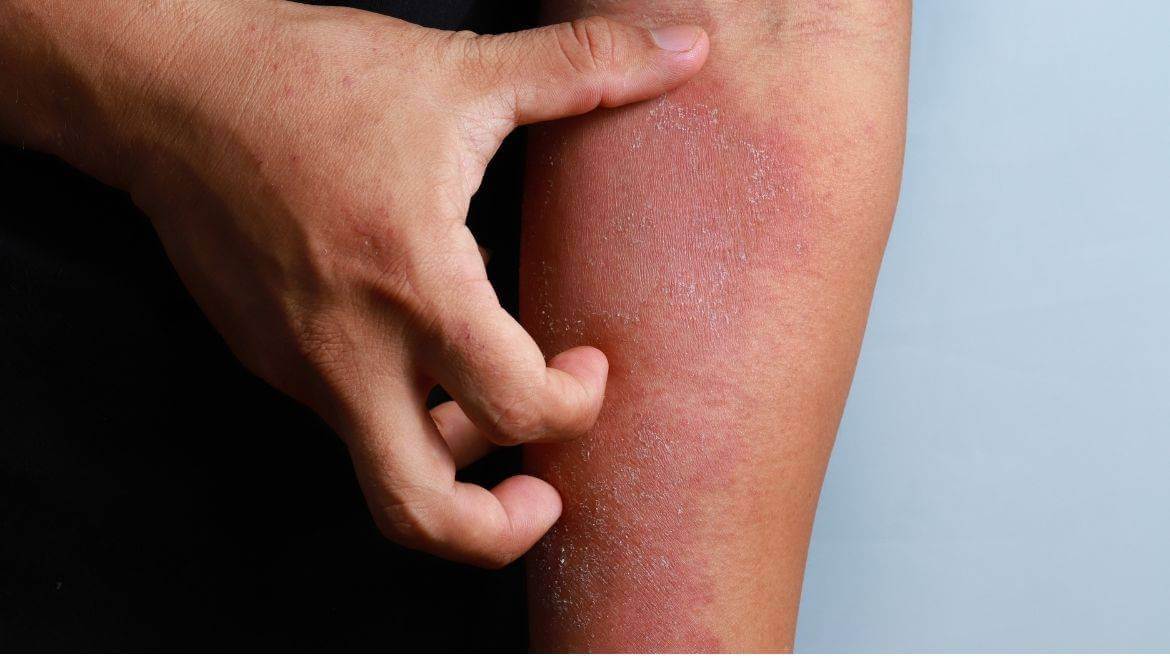 Eczema: Causes, Symptoms and Treatment