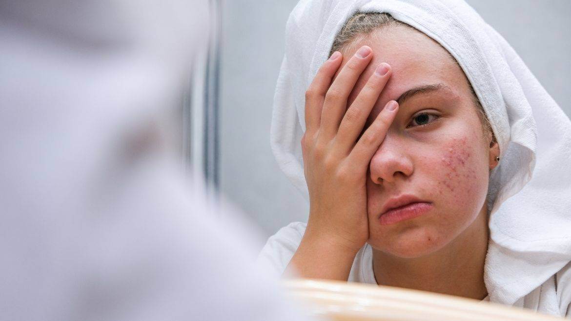 Why Do Some Teenagers Suffer More Acne Than Others?