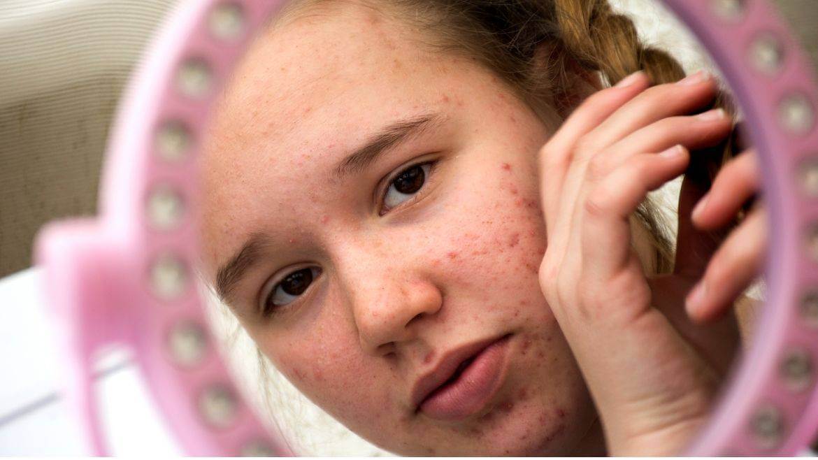 5 Tips That Can Prevent Acne