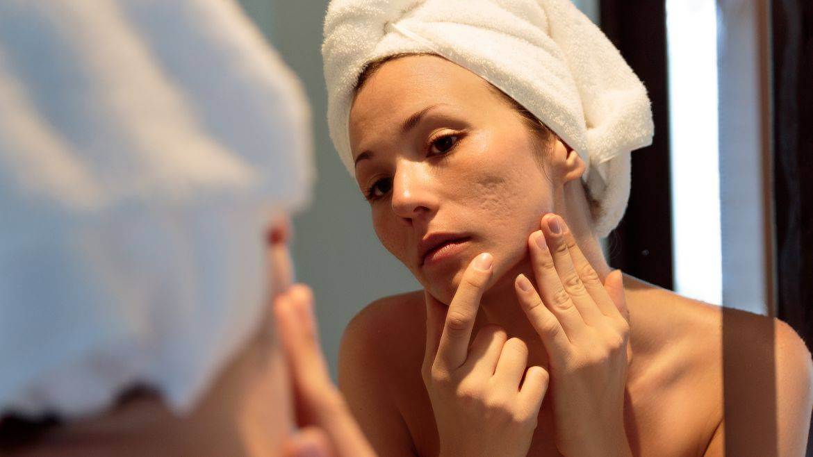Reasons Behind Acne Scars: How to Protect Your Skin?