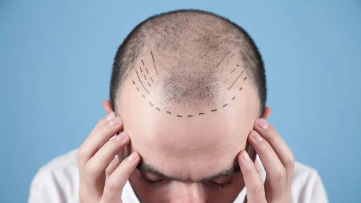 Is Hair Transplant a Good Option?