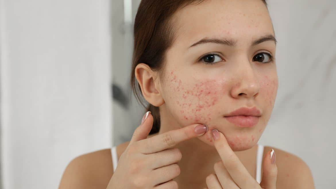 5 Ways to Effectively Prevent Acne in Winter