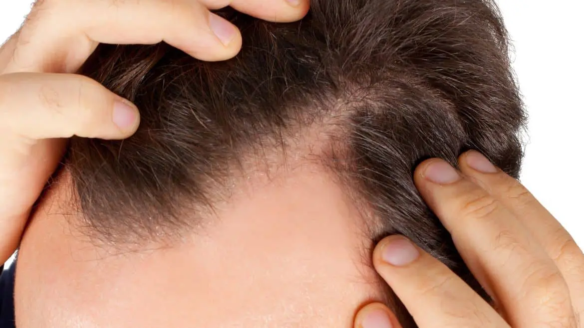 Hair Transplant on Scar: Yes It Works, Here’s How