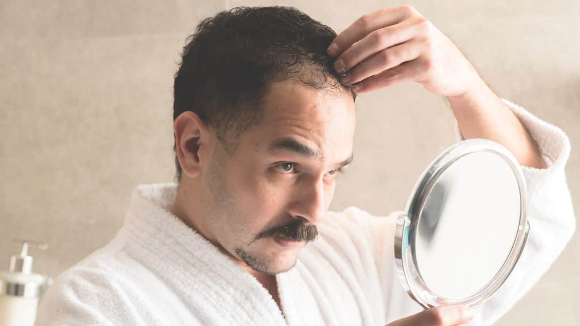 What to Consider Before Having a Hair Transplant