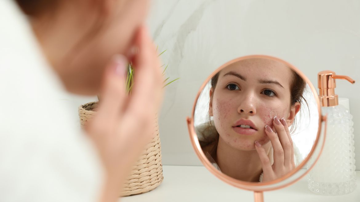 What Every Teen Should Know About Acne