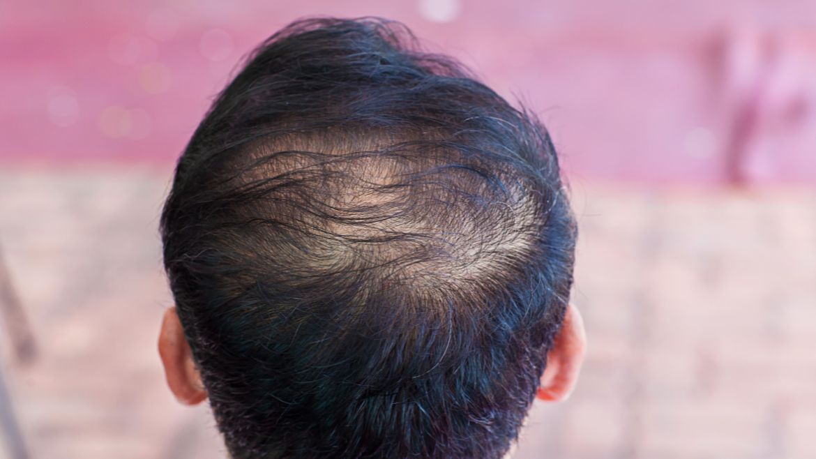 The Psychology of Hair Loss and Hair Transplant: The Impact on Self-Esteem and Confidence