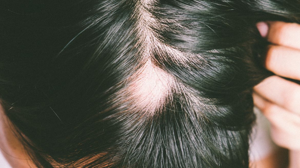 Hair transplant for alopecia: Exploring treatment options for autoimmune-related hair loss