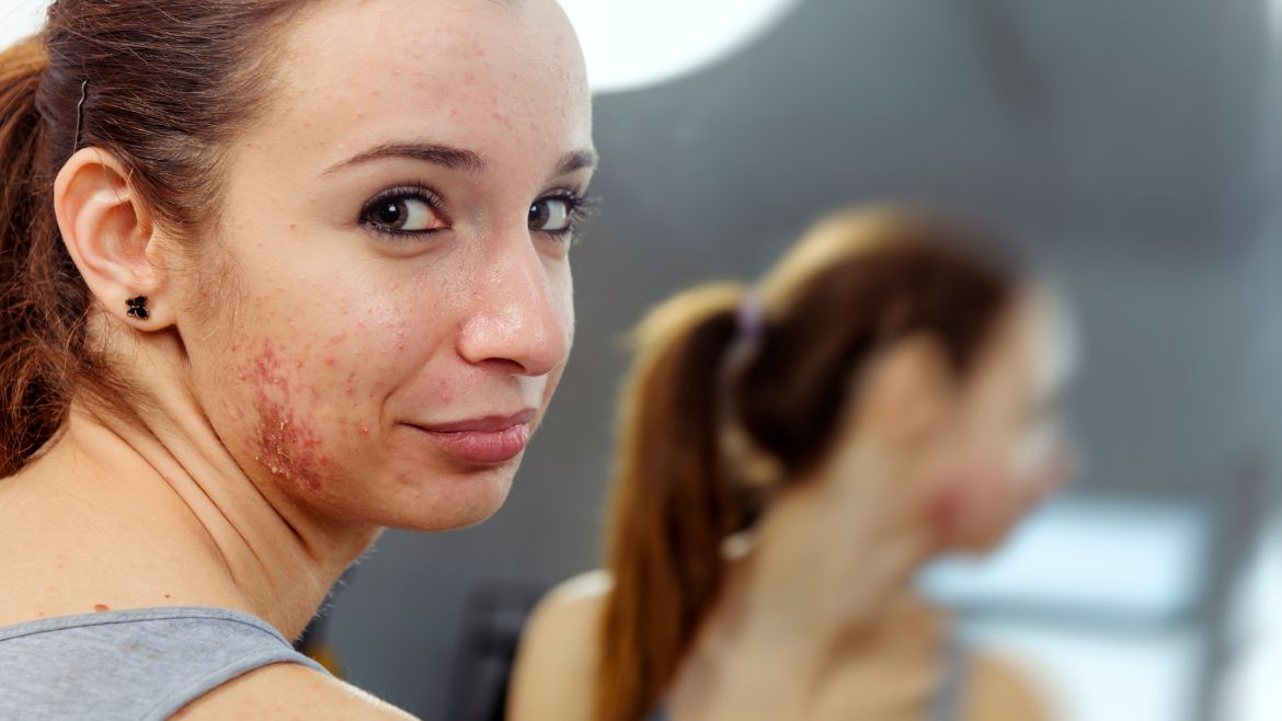 Demystifying Acne: Dermatologist Dr. Abhishek Malviya’s Tips for Clear Skin