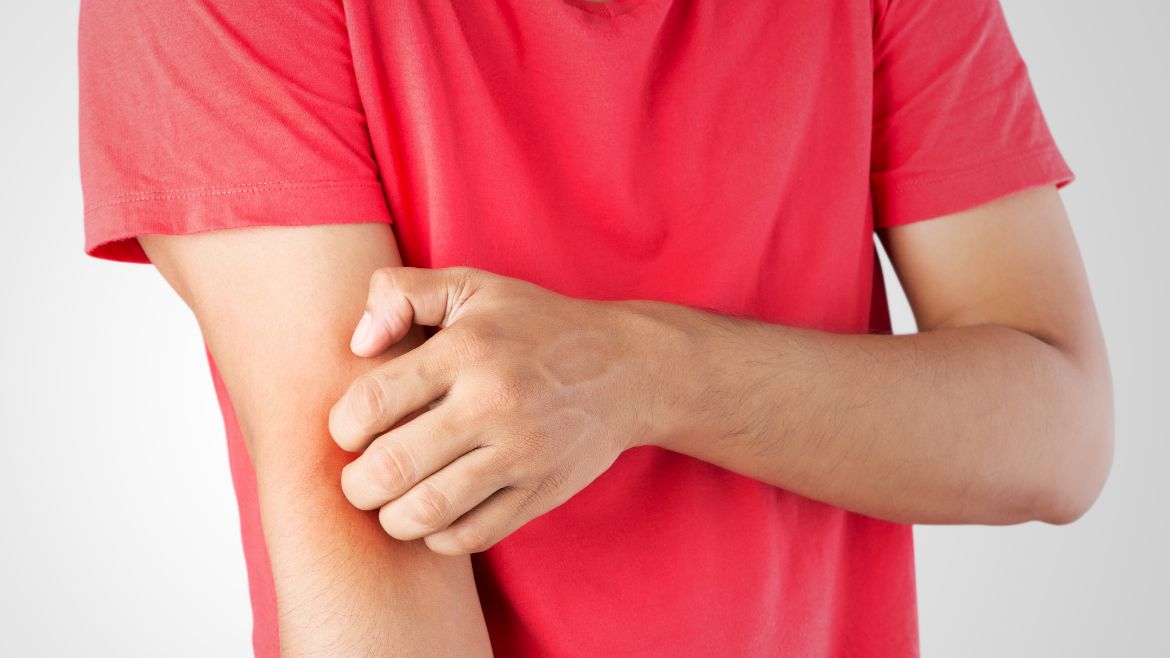 Banishing Eczema: Expert Advice from Dermatologist Dr. Abhishek Malviya