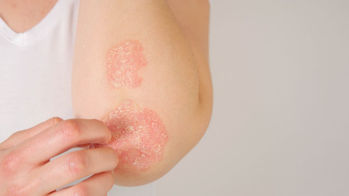 Conquering Psoriasis: Tips and Insights by Dermatologist Dr. Abhishek Malviya