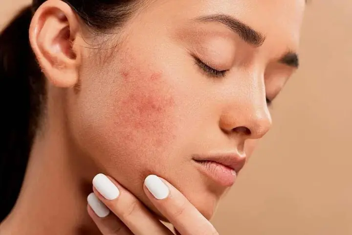 The Connection Between Gut Health and Skin Conditions Like Acne and Psoriasis