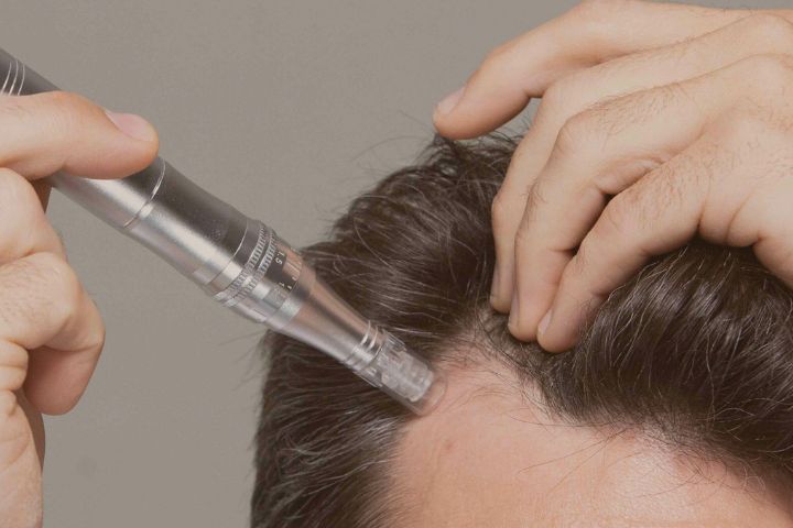 Microneedling for Hair Regrowth