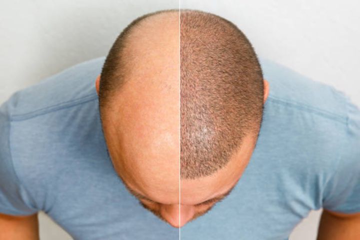 Non-Surgical Alternatives to Hair Transplants: Do They Work?