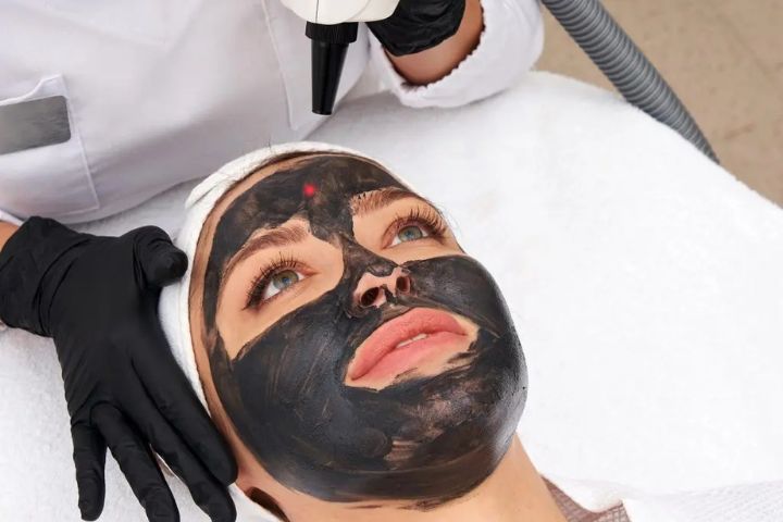 Carbon Laser Peels: The Perfect Solution for Dull Skin