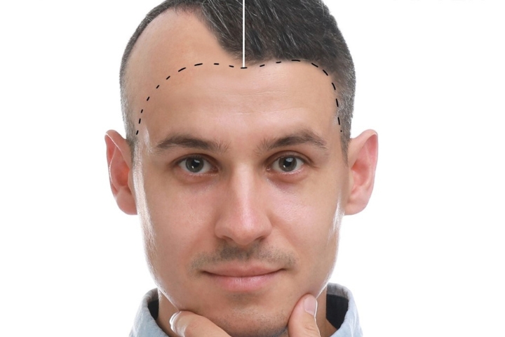 What Makes Hair Transplant Results Look Natural?