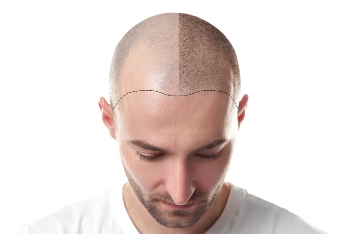 Scalp Micropigmentation: A Game-Changer for Thinning Hair