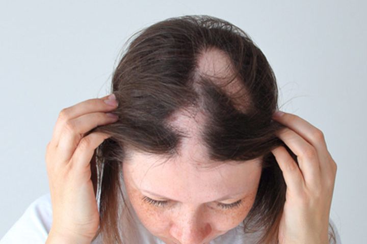 Telogen Effluvium vs Androgenic Alopecia: What’s Causing Your Hair Fall?