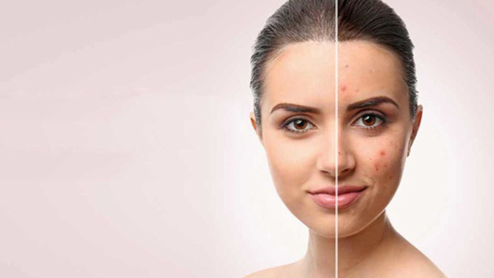 How to Choose the Right Moisturizer for Acne-Prone Skin
